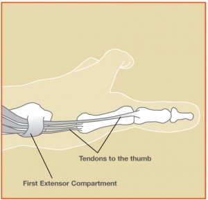 dequervains tendonitis treatment in raleigh by dr erickson