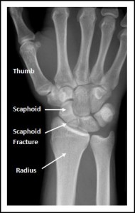 Scaphoid Fracture