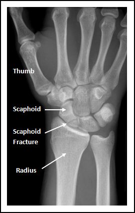 scaphoid fracture thumb numbness)
