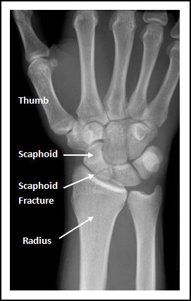 scaphoid fracture cast time