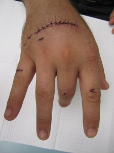 extensor tendon laceration1