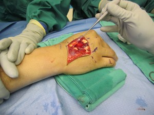 extensor tendon laceration2