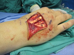 extensor tendon laceration3