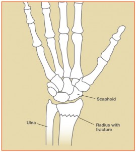 WristFracture