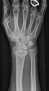 distal radius fracture 1