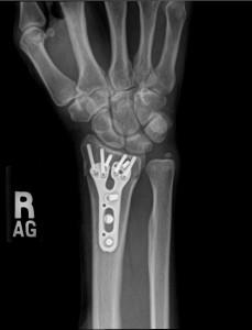 distal radius fracture ORIF 1