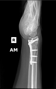 distal radius fracture ORIF 2