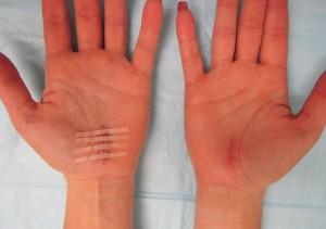 carpal tunnel incision