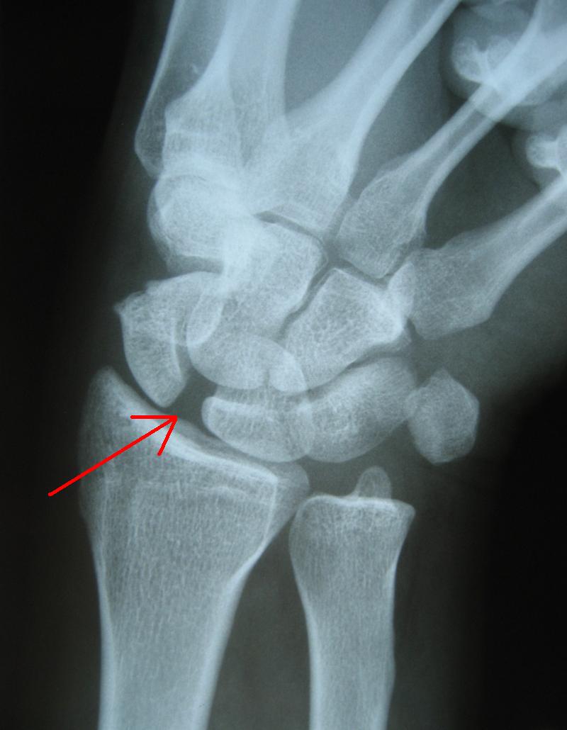 Scapholunate Ligament Injury - John Erickson, MD