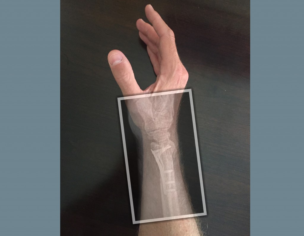 Distal Radius Fracture