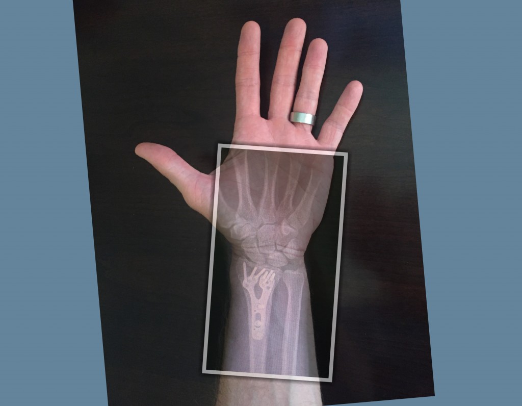 Distal Radius Fracture 4