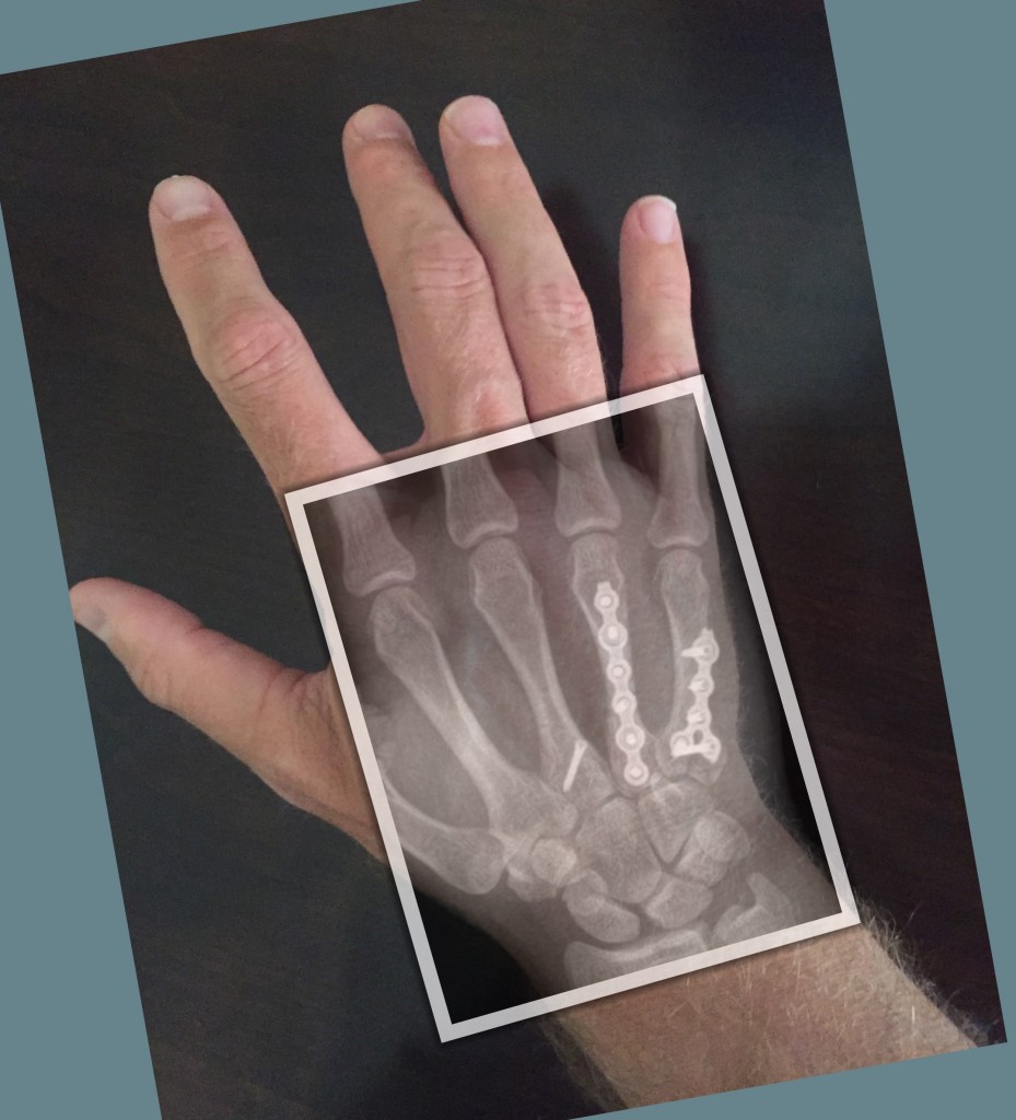 Metacarpal Fracture ORIF