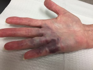 Major bruising after Xiaflex
