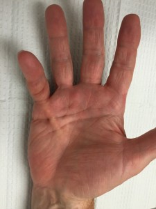 Dupuytrens contracture in small finger