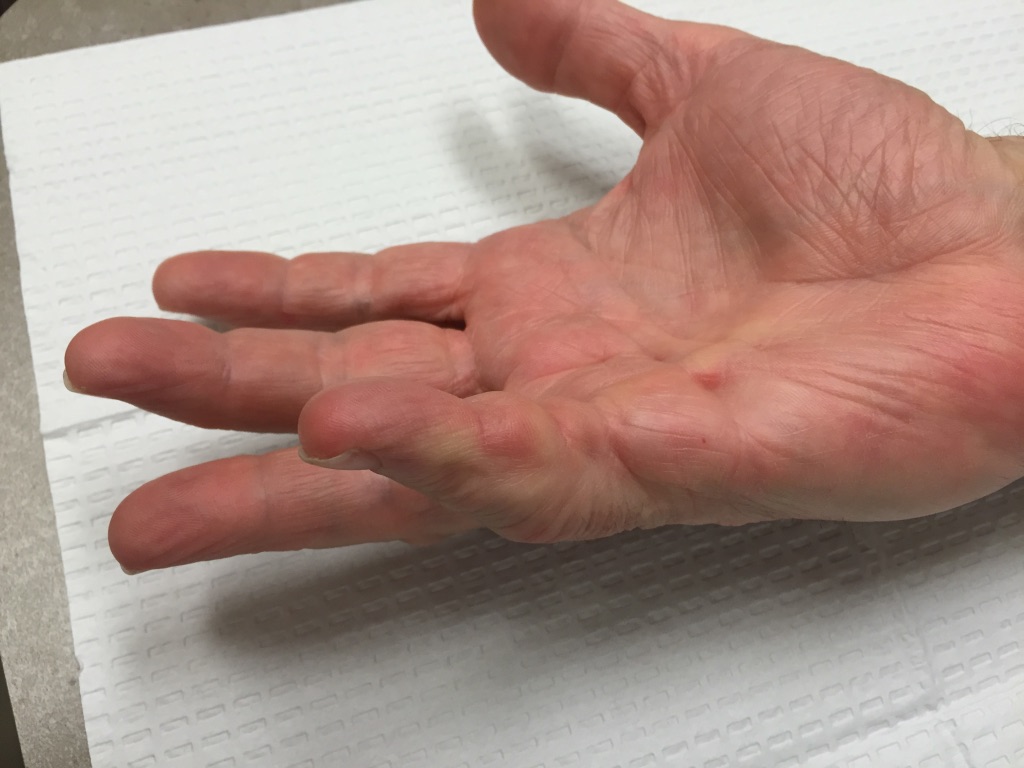 Pictures Of Dupuytrens Disease Hands John Erickson Md