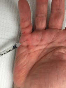 Injection of Xiaflex
