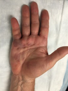 Mild bruising after Xiaflex