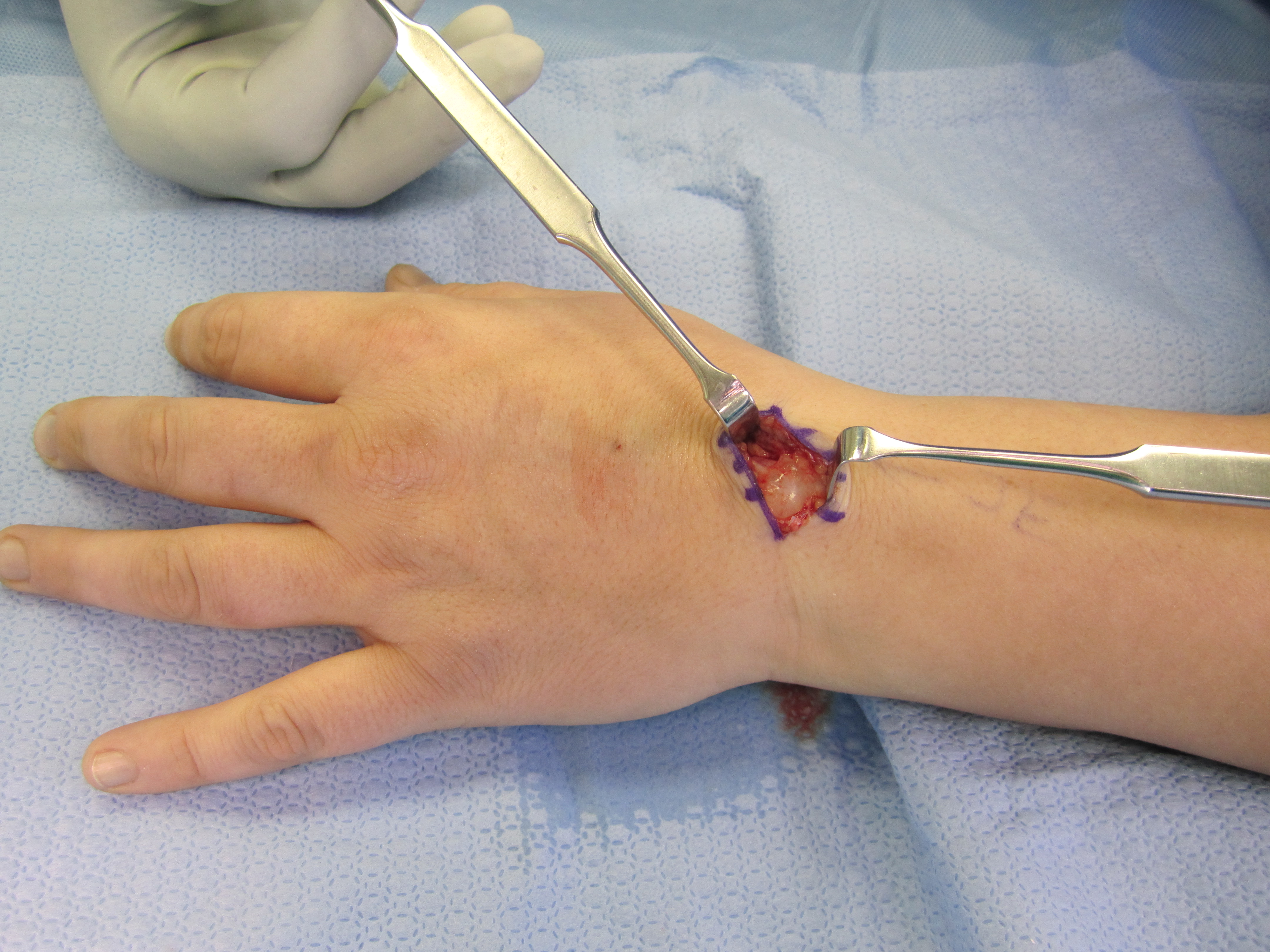 Lumps, Bumps, and Cysts in the Hand - John Erickson, MD