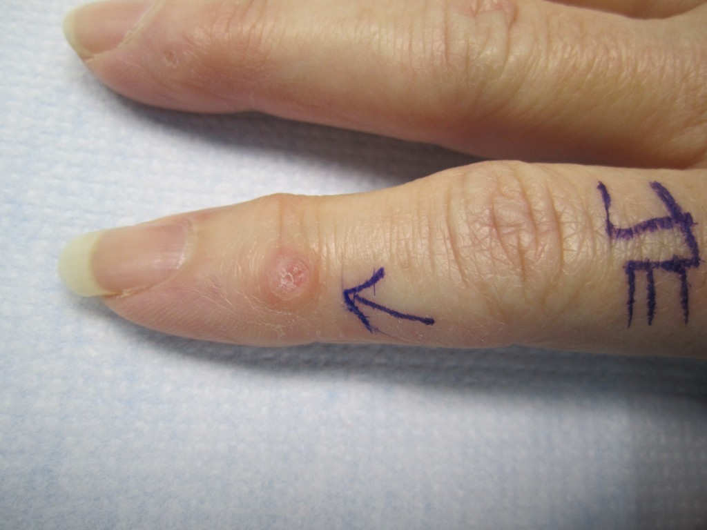 mucous cyst in finger