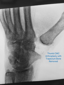 ThumbCMCArthroplasty