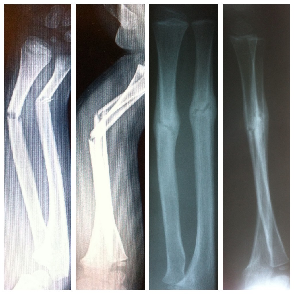 Pediatric Both Bone Forearm Fracture