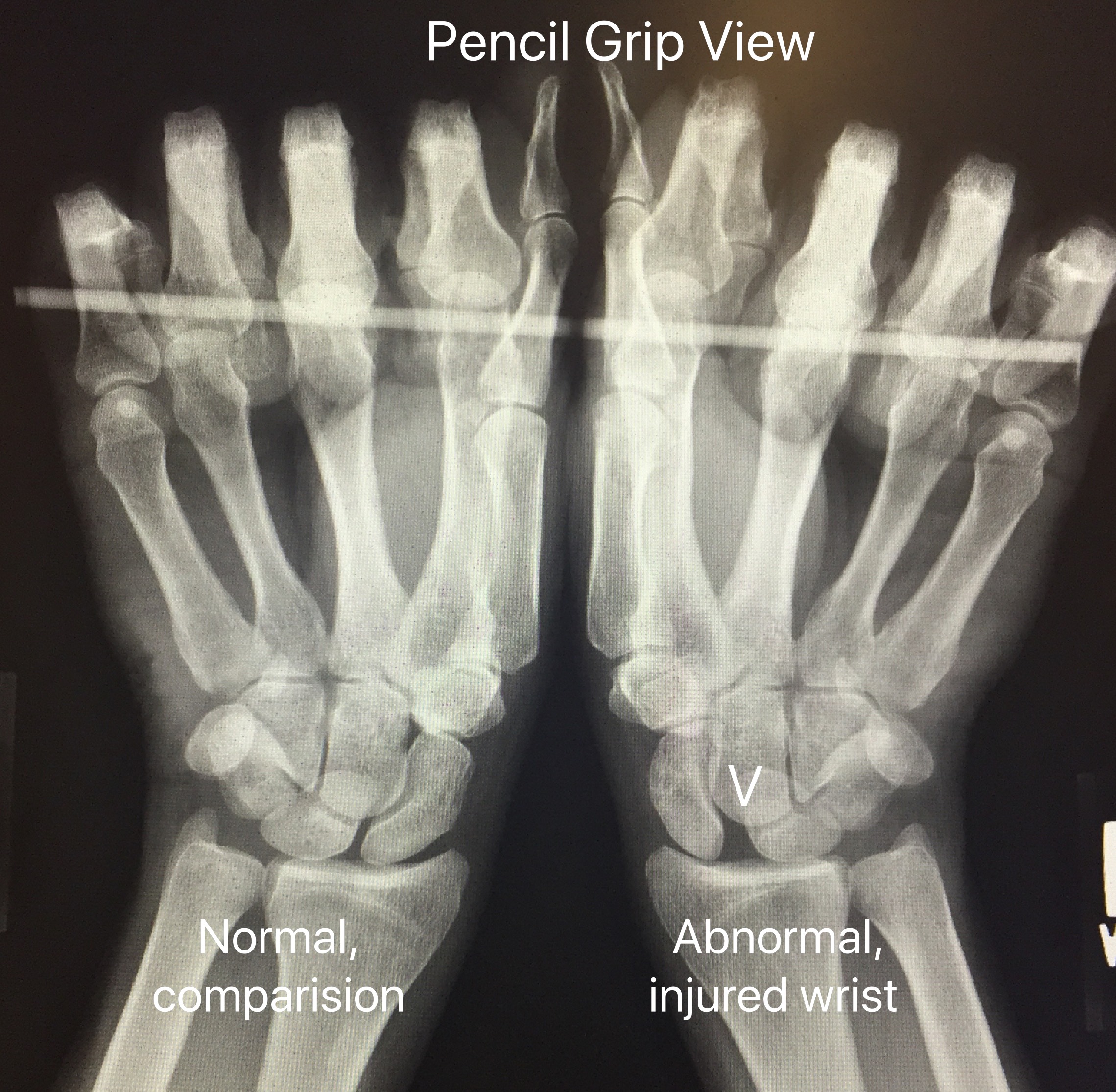 pisiform bone wrist lump