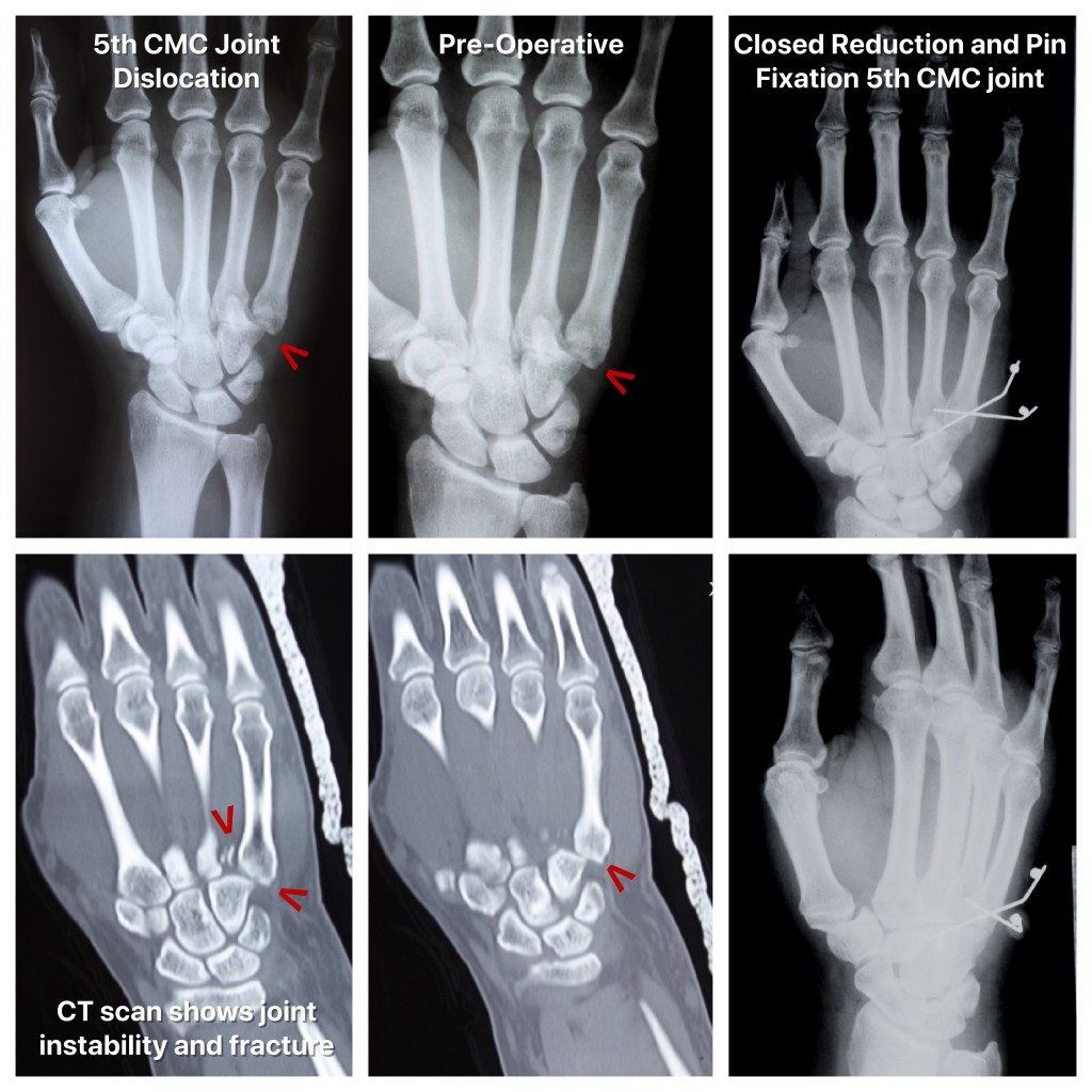 5TH CMC Fracture Dislocation 2