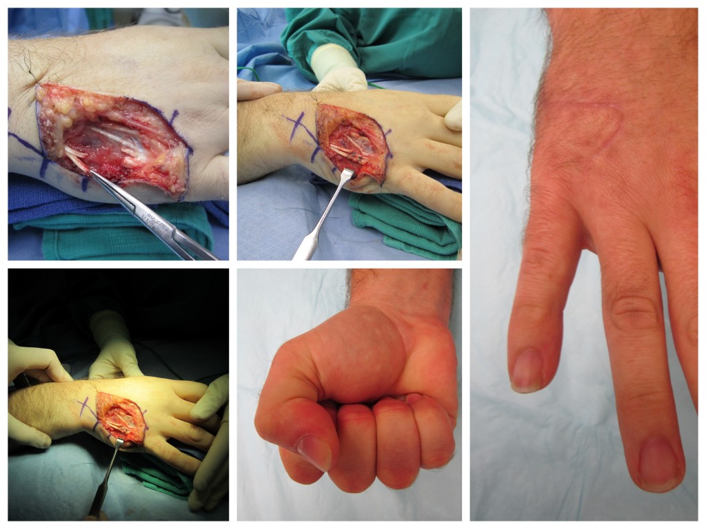 Extensor Tendon Repair