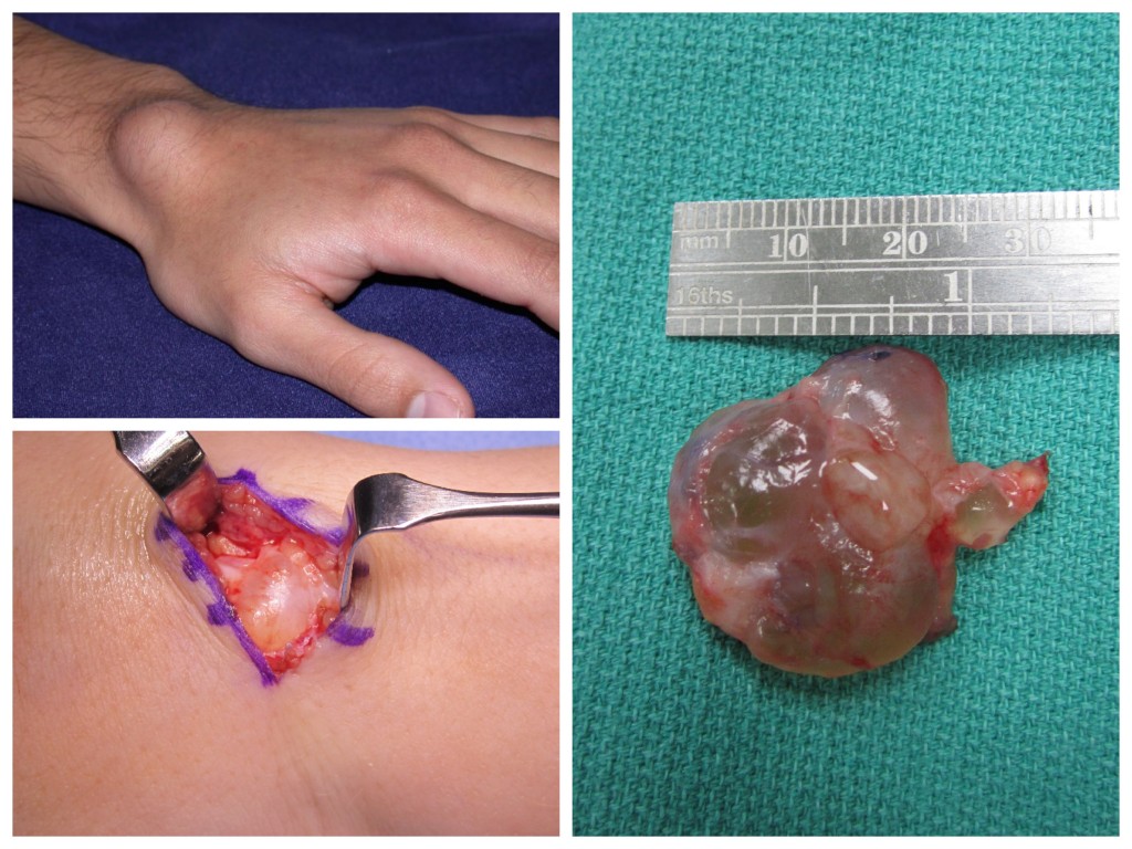 Ganglion Cyst Excision