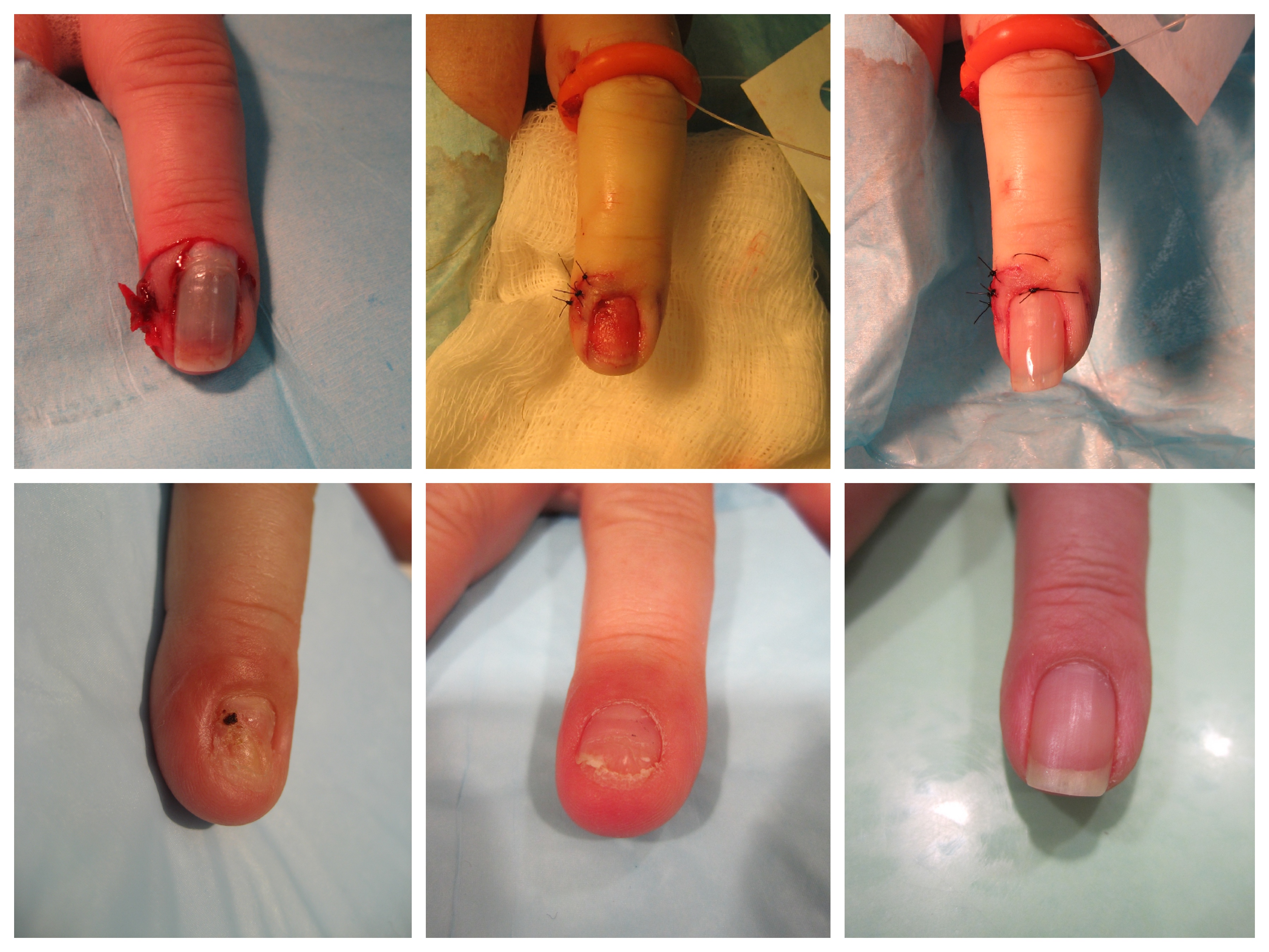 Surgical Repair of Fingernail Injury - John Erickson, MD