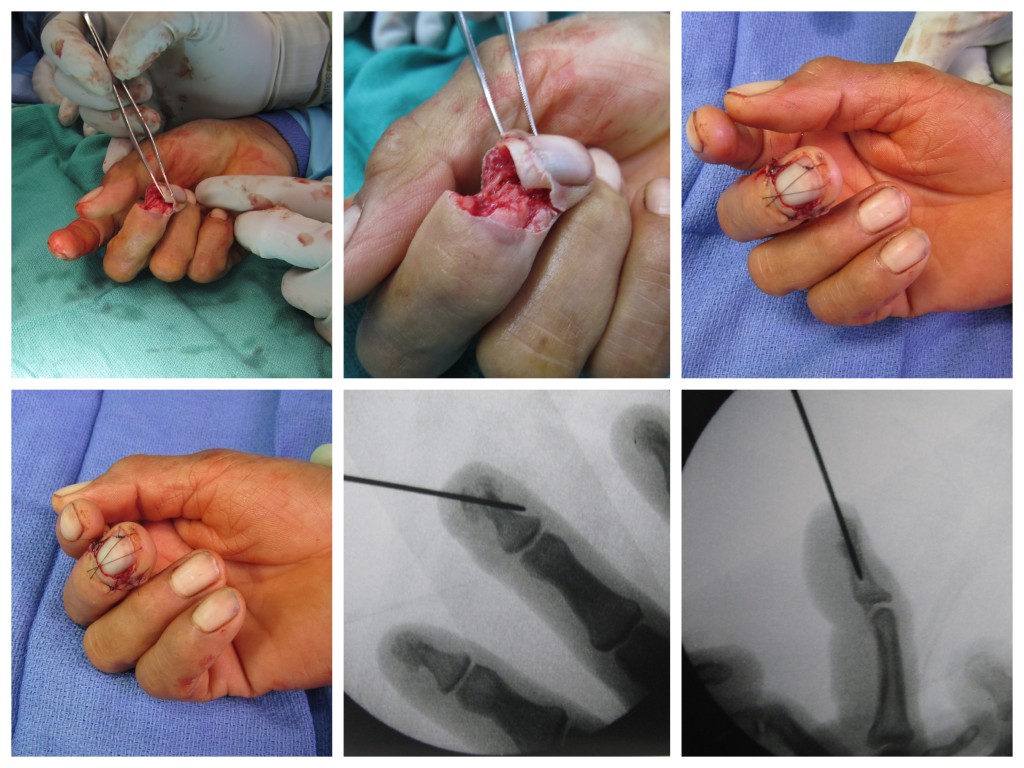 Open Fracture Distal Phalanx Finger