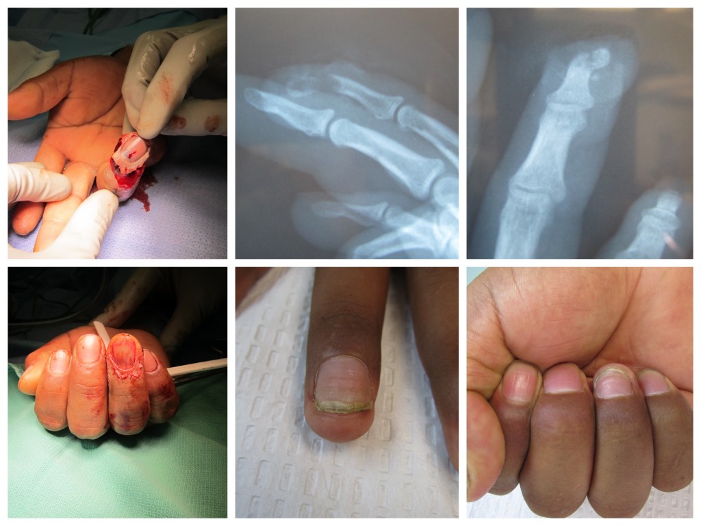 Partial Fingertip Amputation