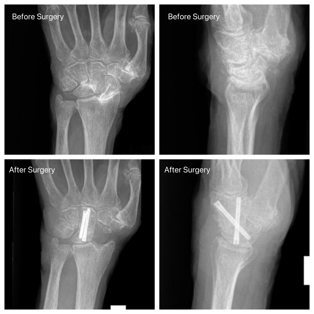 Scaphoid Excision Midcarpal Fusion 2