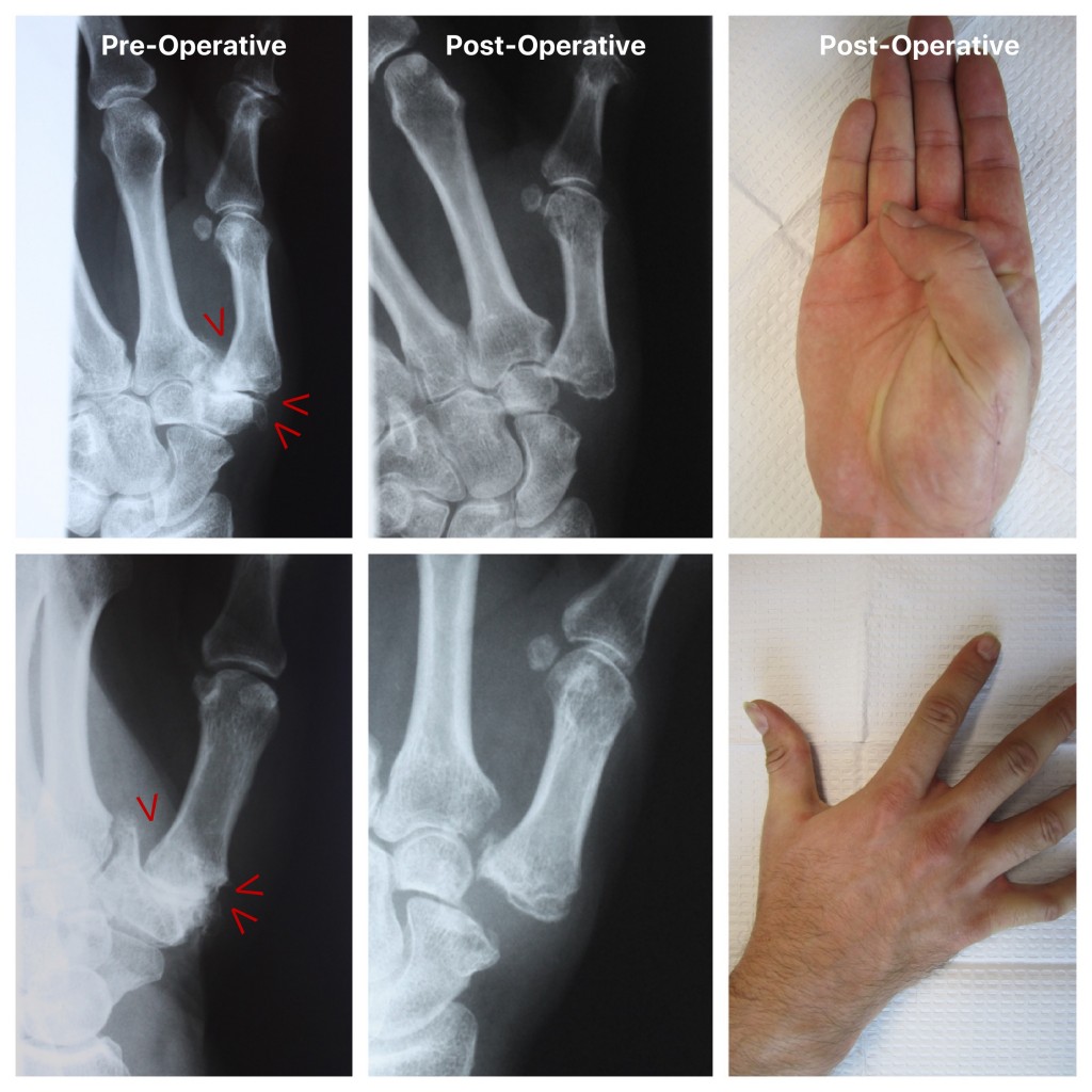 Thumb CMC Arthroplasty 2