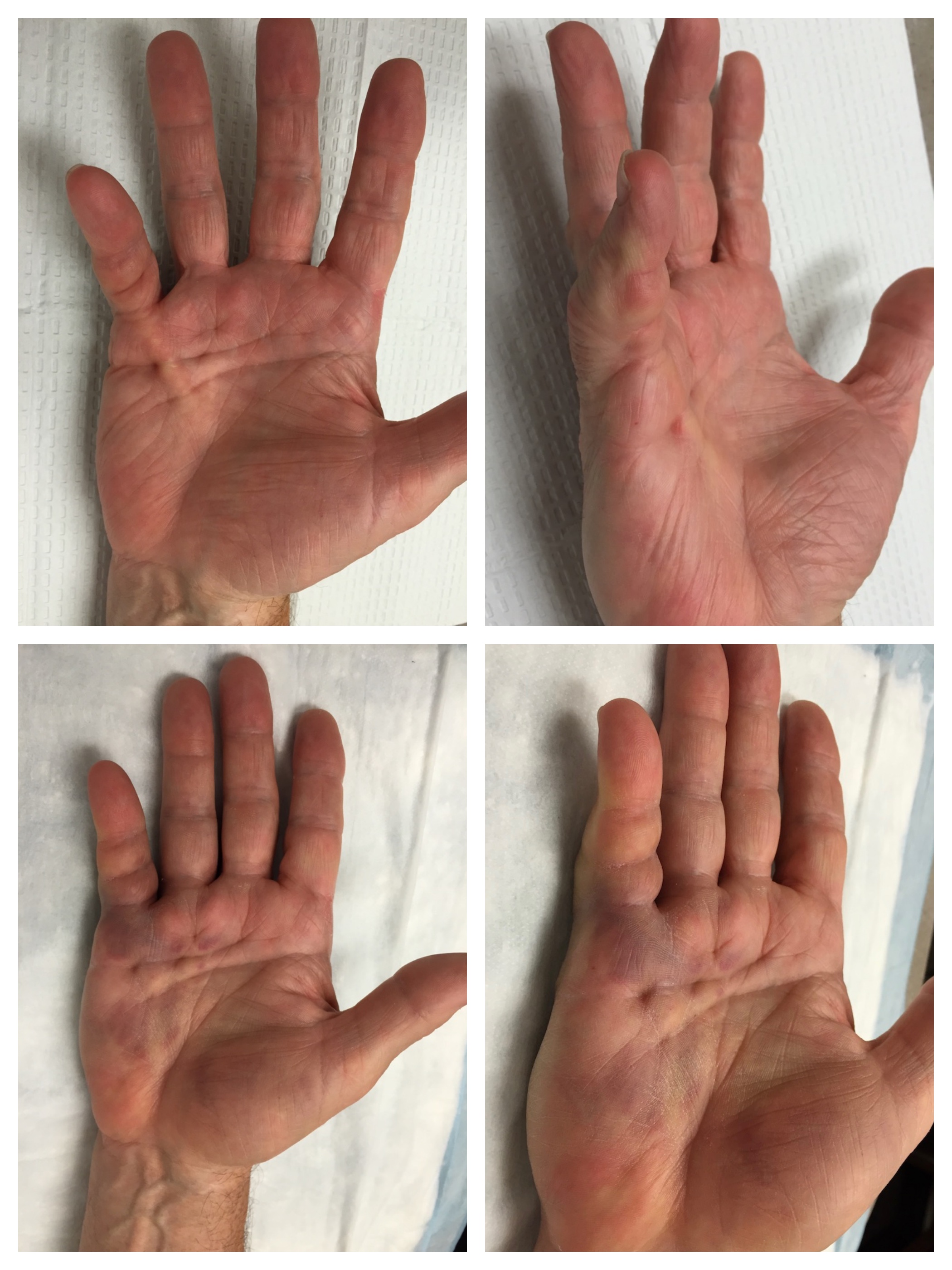 less-invasive-dupuytren-s-treatment-at-raleigh-hand-john-erickson-md