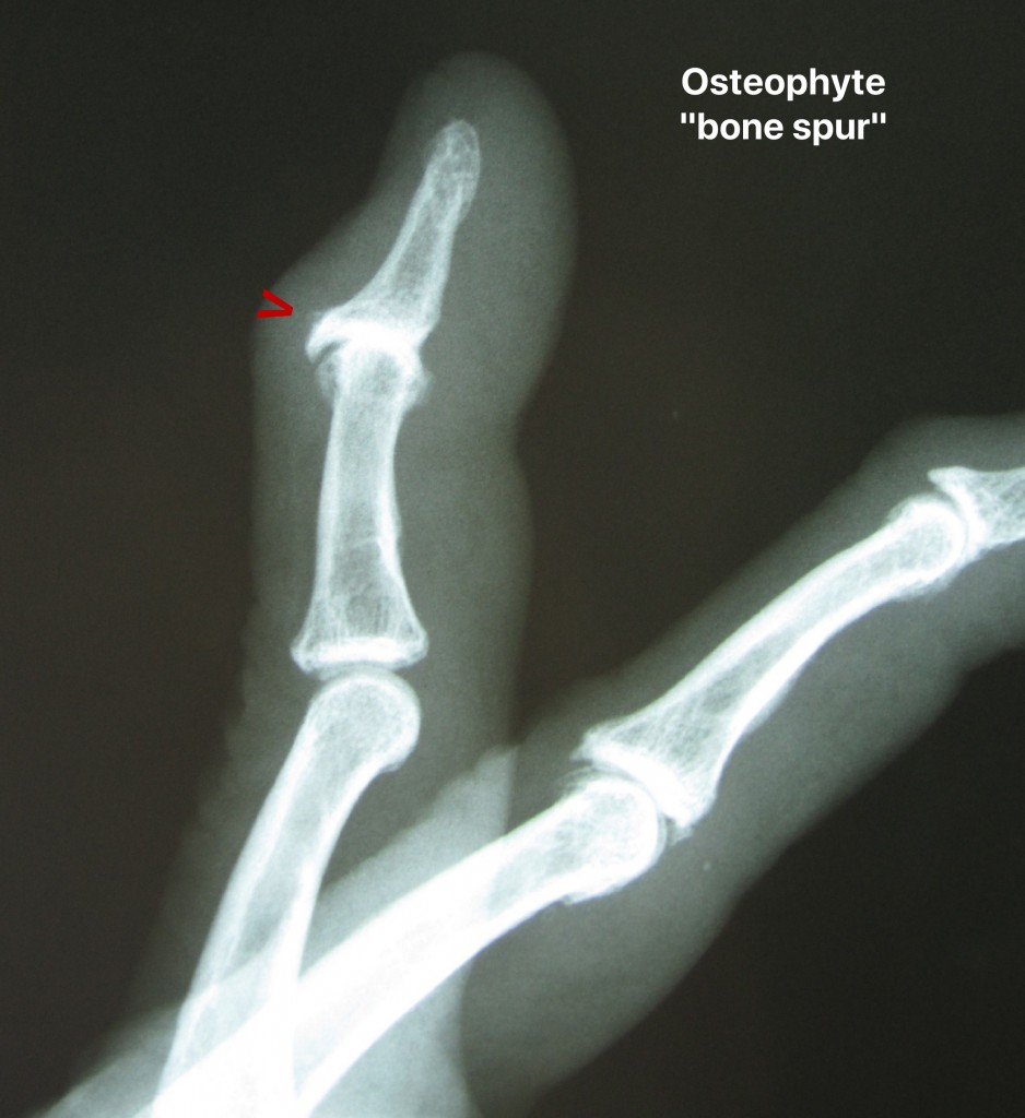 osteophyte bone spur