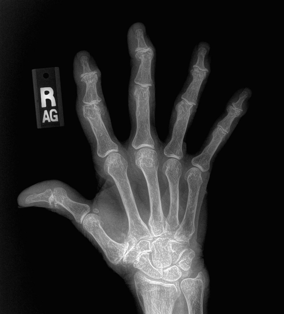 hand osteoarthritis