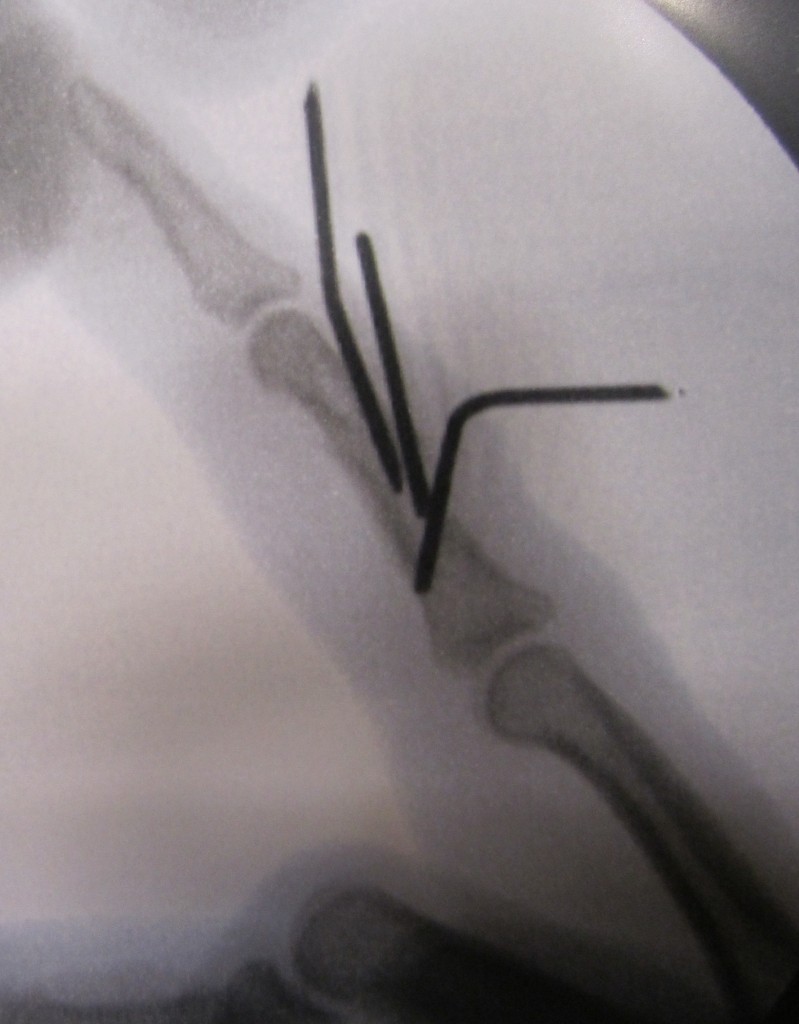 LessInvasive Finger Fracture Treatment John Erickson, MD