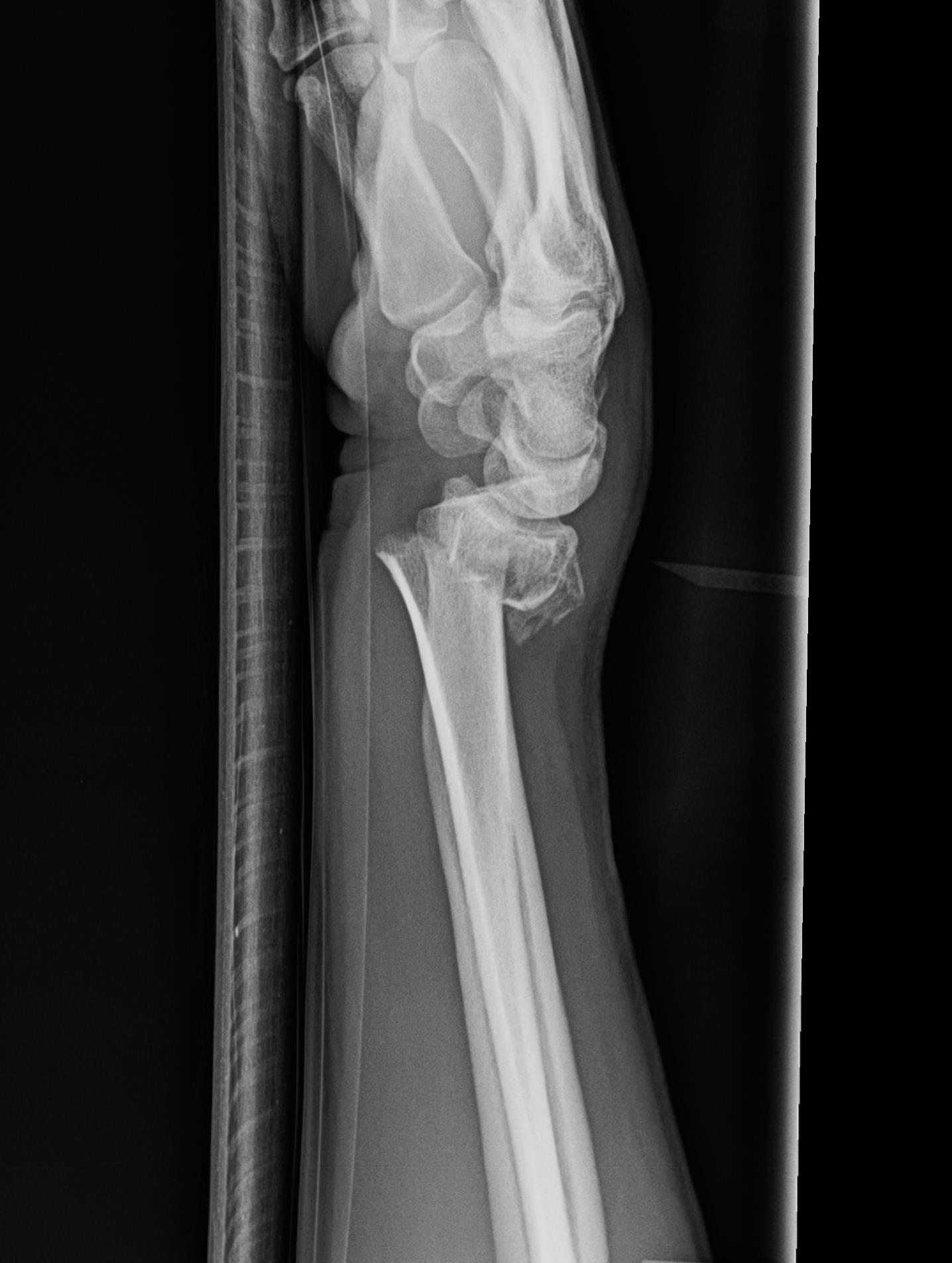 Xrays Of Broken Wrist