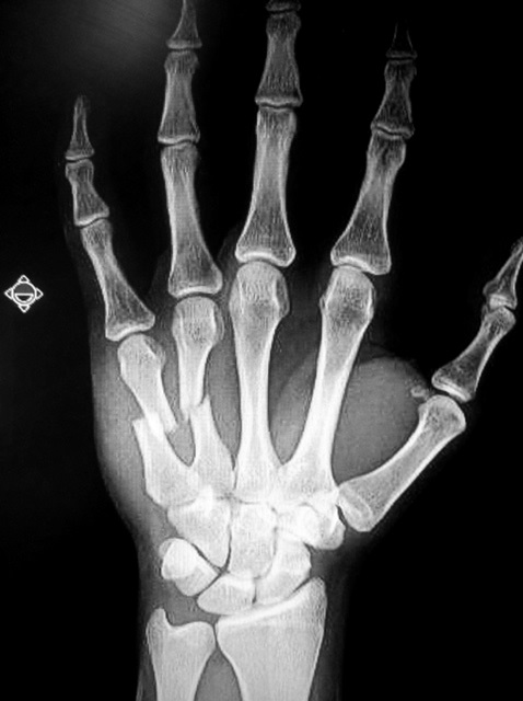 define meta in metacarpal