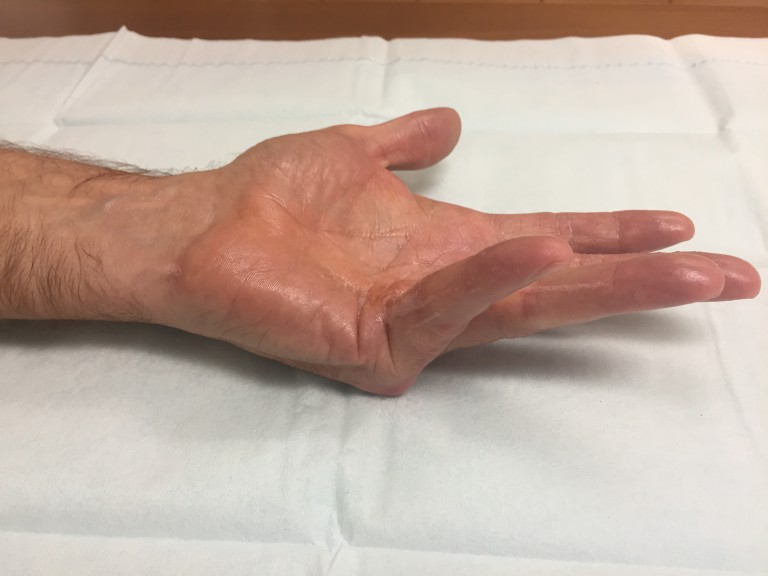 Needle Aponeurotomy for Dupuytrens at Raleigh Hand John Erickson, MD