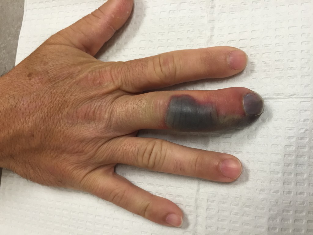 Treatment of Snake Bite Injuries to the Hand in North Carolina John