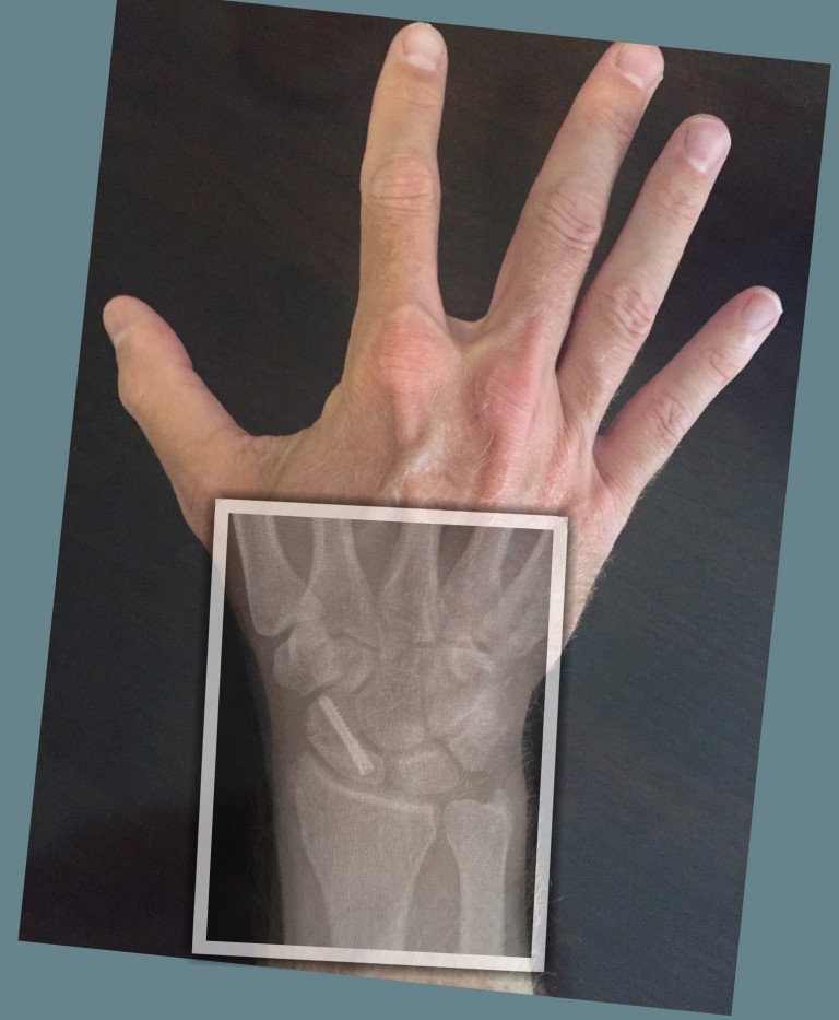 Scaphoid fracture John Erickson, MD