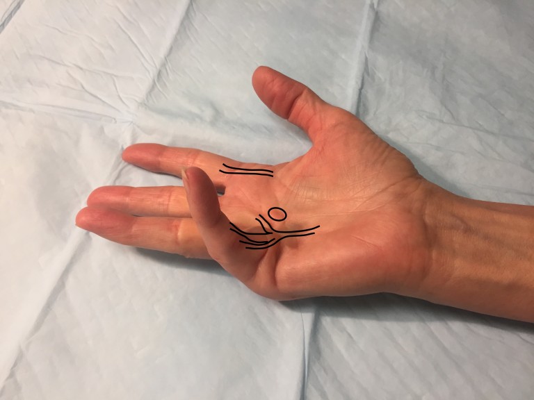 Dupuytrens Contracture Treatment by Dr Erickson in Raleigh