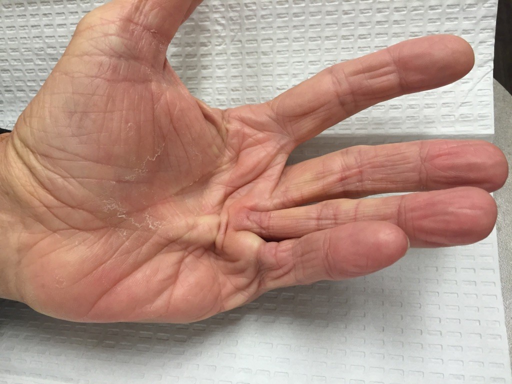 Dupuytren's contracture