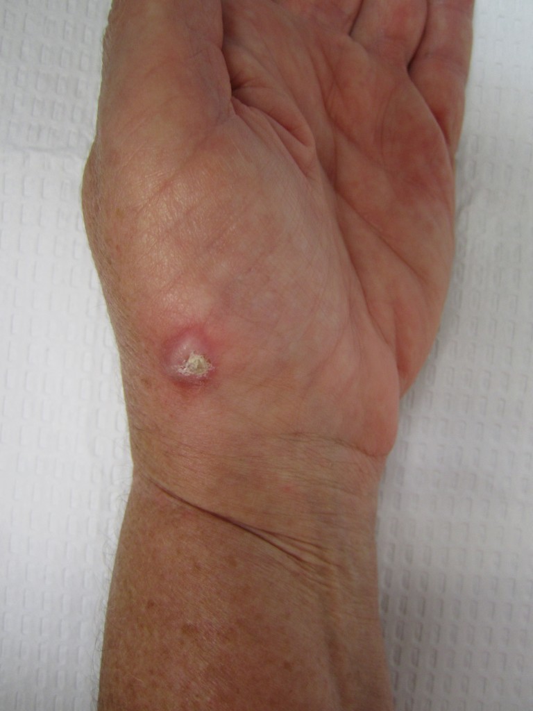 squamous cell carcinoma at base of thumb
