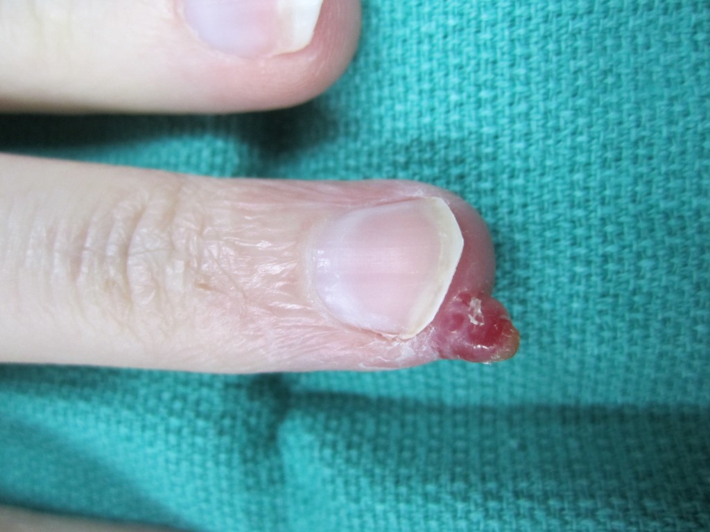 Pyogenic Granuloma on Fingertip