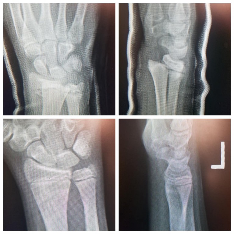 wrist fractures in children
