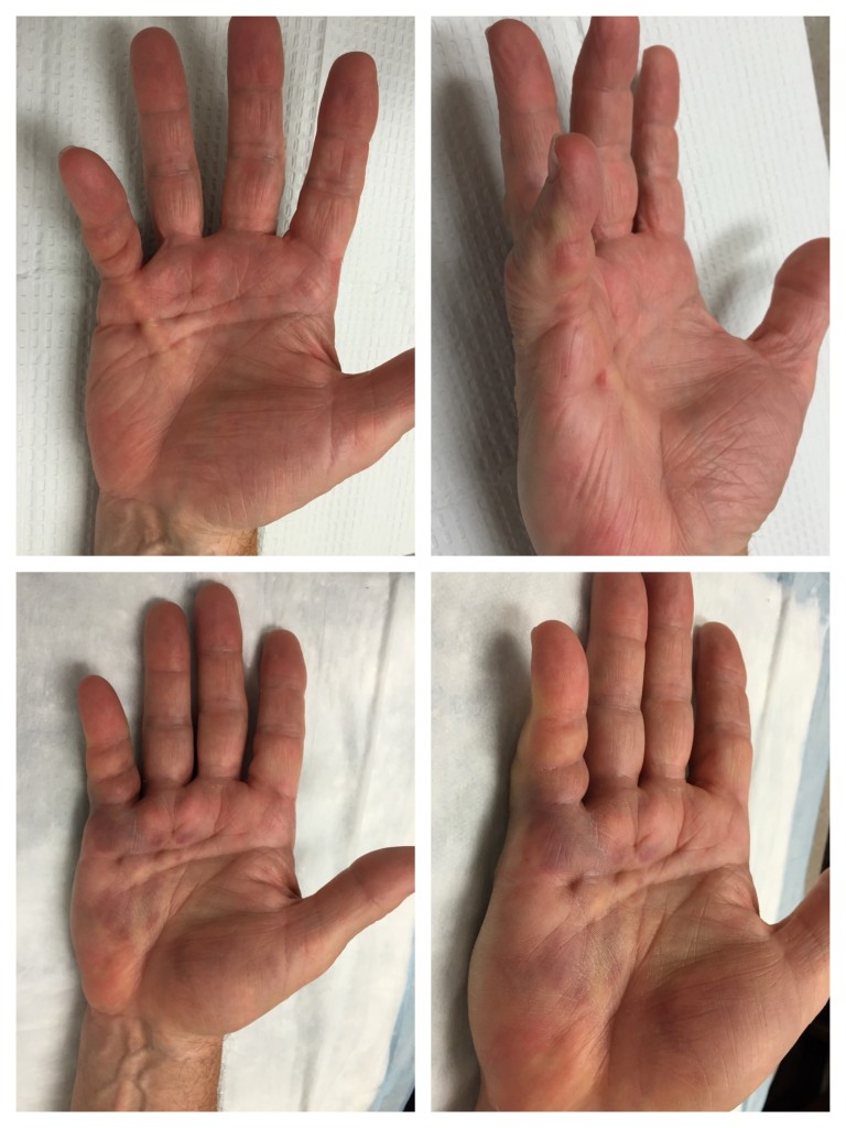nonsurgical-treatment-dupuytrens-contracture