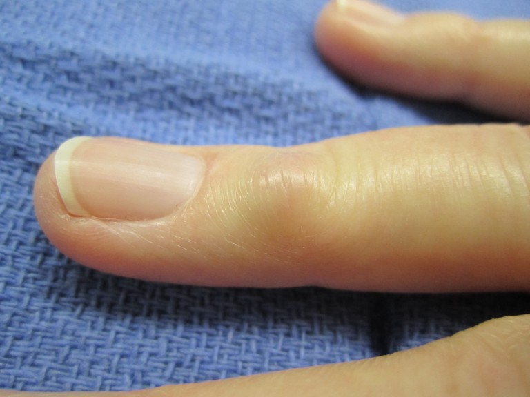 Mucous Cysts in Fingers